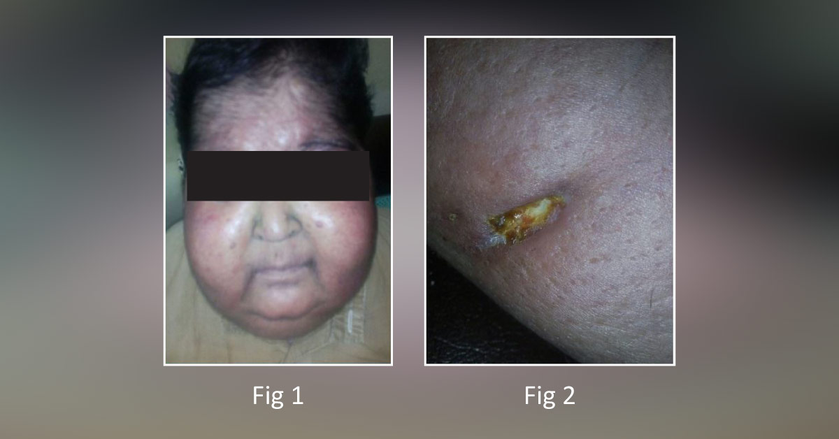 A Morbidly Obese Young Man With Oozing Skin Ulcers